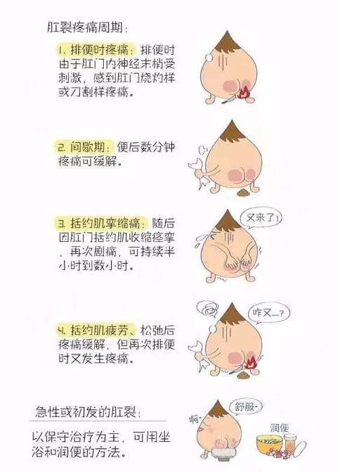 难以启齿的肛裂